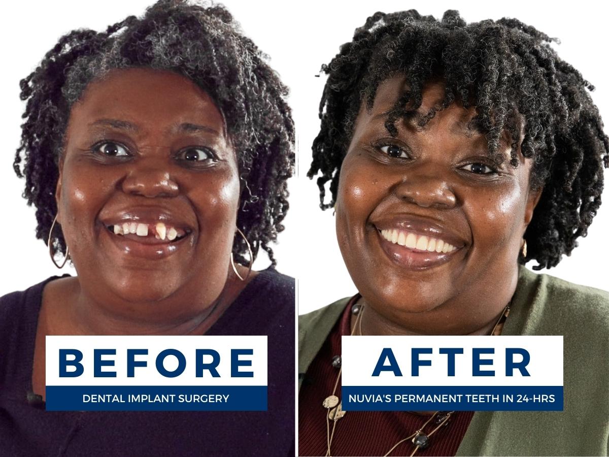 24 Hour Dental Implants Austin, TX Nuvia Dental Implant Center
